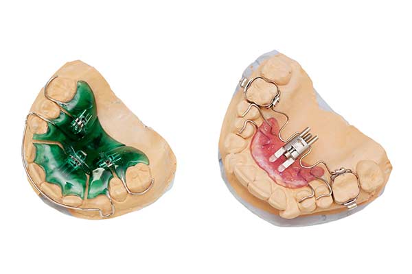 Palatal expanders on clay models